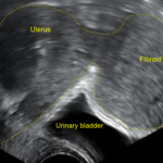 Fibroid uterus