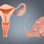 Ovarian cysts