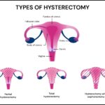 All you need to know about hysterectomy